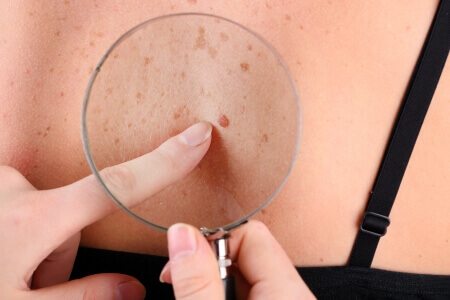 נקודות חן: מתי מדובר בסימני אזהרה לסרטן העור?