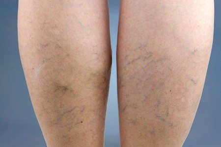 ורידים בולטים ברגליים: טיפול חדשני ללא ניתוח בהזרקת קצף