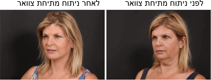 לפני ואחרי מתיחת צוואר ד"ר ליאורה הולנדר 