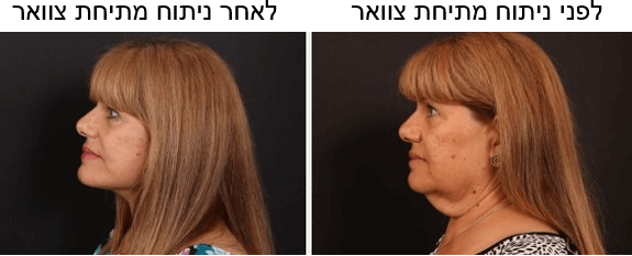 לפני ואחרי ניתוח מתיחת צוואר ד"ר הולנדר