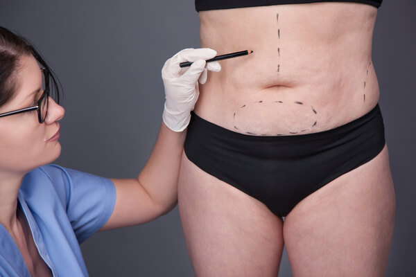 ניתוח הסרת עודפי עור לאחר ירידה במשקל