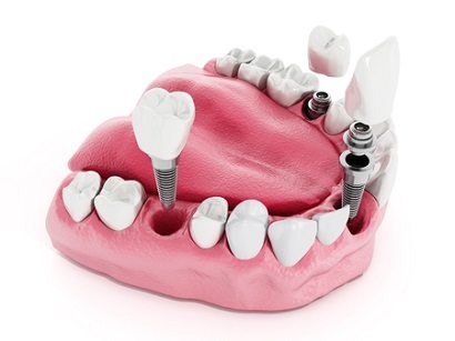 השתלות שיניים בהרדמה כללית: הדרך הקלה ביותר לעבור טיפולים מורכבים