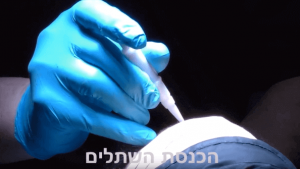 השתלת שיער ללא צלקות דר שאלתיאל