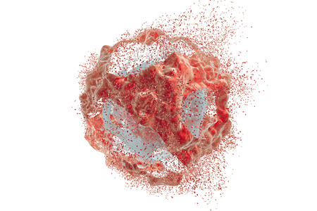כירורגיה של סרטן הלבלב: הטכנולוגיה החדשה לטיפול
