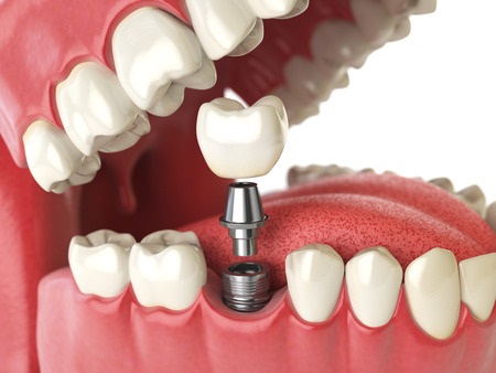חידושים טכנולוגיים בהשתלות שיניים: פרוצדורה נטולת סיבוכים