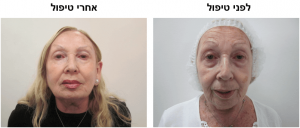 לפני ואחרי טיפול דר עודד רודניצקי