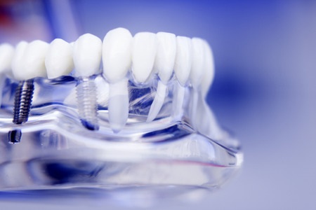 תכנון שיקומי בהשתלת שיניים ממוחשבת: דיוק ויעילות במינימום כאב