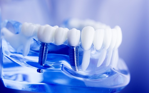 השתלת שיניים ושיקום הפה: כך עושים את זה נכון