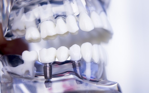 השתלת שיניים בשיטת All on 4: טיפול אחד ותוצאות מידיות