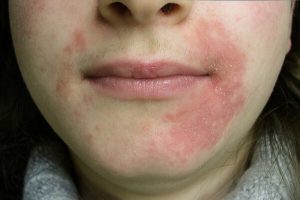 רוזציאה Rosacea