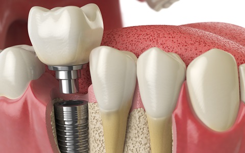 השתלות שיניים ופתרונות למחוסרי עצם: לחסוך זמן, כסף וסיבוכים