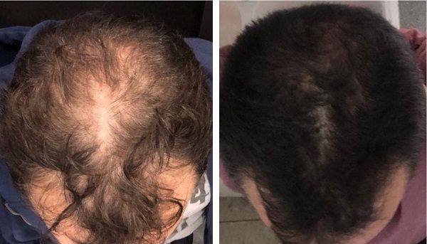 לפני ואחרי דר טיפול PRP לנשירת שיער דר מאיר באבאיב