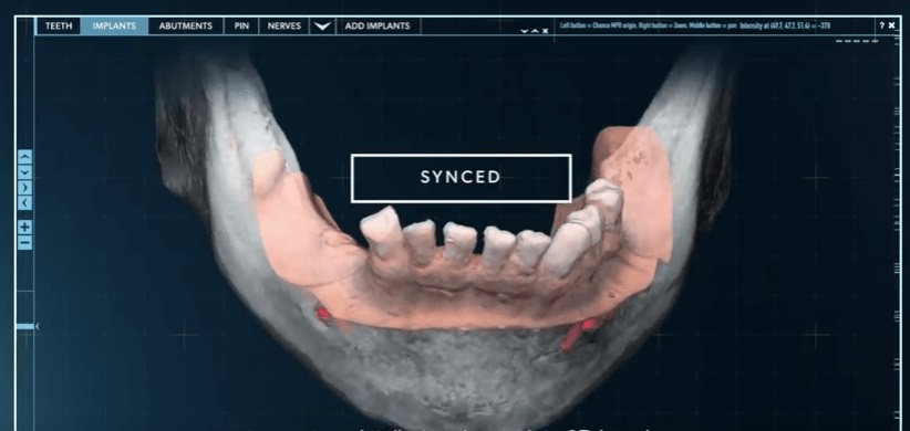 חידושים בהשתלות שיניים: הטכנולוגיה שתחזיר לך את החיוך