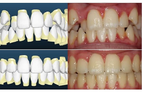 הטכנולוגיה המתקדמת ליישור שיניים: התאמה ממחושבת