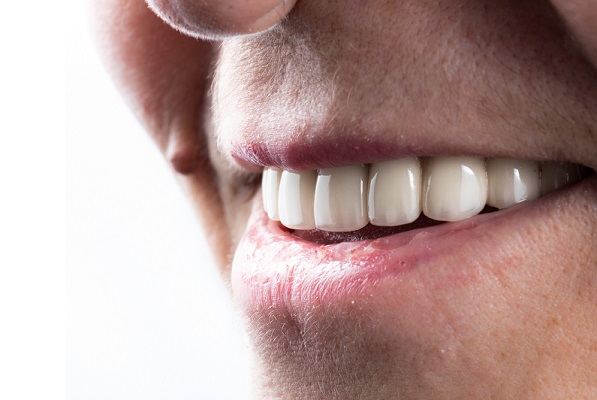 השתלת שיניים בזאלית: השיטה הייחודית