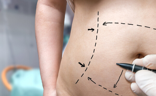 ניתוח מתיחת בטן: להיפטר מעודפי העור