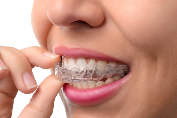יישור שיניים שקוף: המהפך של נדין