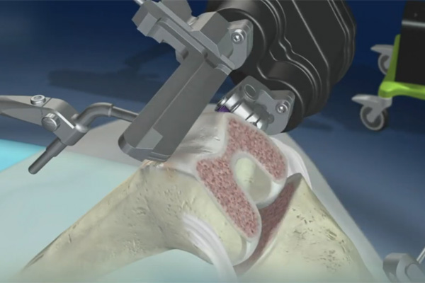 ניתוח רובוטי להחלפת ברך