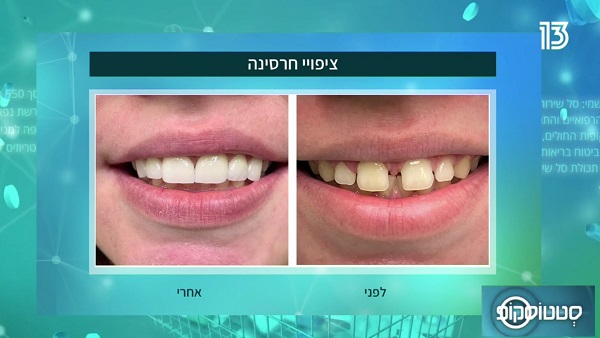 החיוך המושלם: מתי מומלץ לעשות ציפויי חרסינה בשיניים?