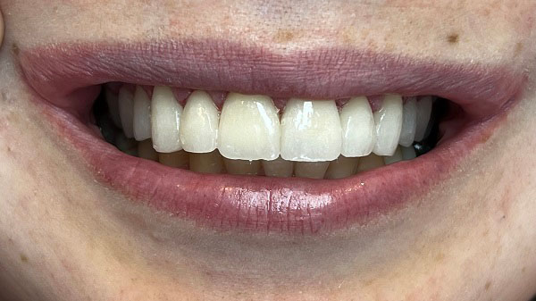 לחייך מחדש: ציפויי חרסינה לשיניים
