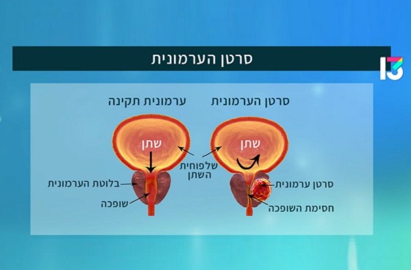 טיפולים הורמונליים לסרטן הערמונית