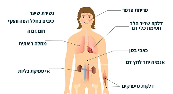 מהי מחלת הלופוס וכיצד ניתן לטפל בה?