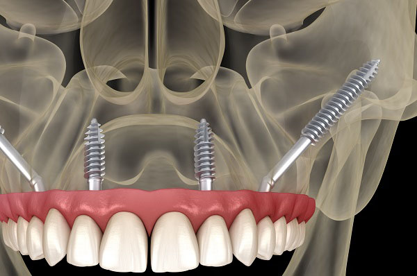 השתלת שיניים גם לחסרי עצם - שתלים זיגומטיים