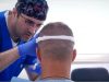 נשירת שיער: הטיפול החדשני באמצעות PRP